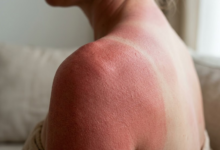 moters oda raudona, nudegusi saulėje