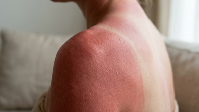 moters oda raudona, nudegusi saulėje