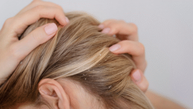 moters plaukai su pleiskanom