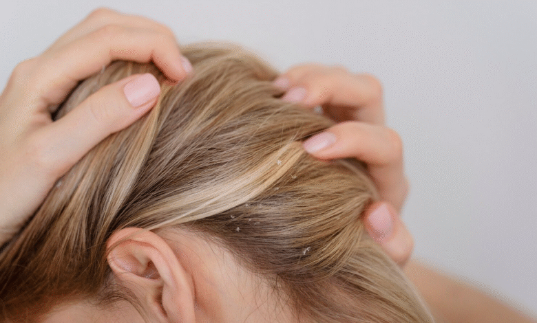 moters plaukai su pleiskanom